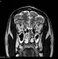 Normal coronal brain (Radiopaedia 6676-7910 Coronal T2 5).jpg