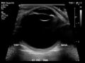Normal eye ultrasound (Radiopaedia 70415-80514 A 2).jpg