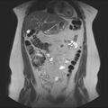 Normal liver MRI with Gadolinium (Radiopaedia 58913-66163 Coronal T2 14).jpg