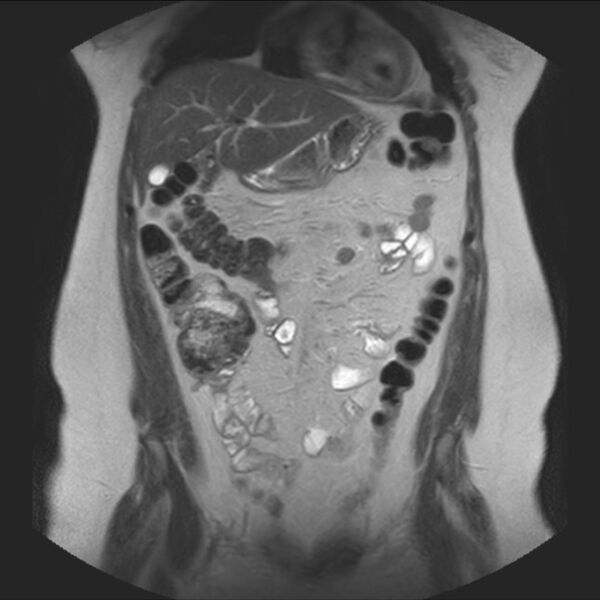 File:Normal liver MRI with Gadolinium (Radiopaedia 58913-66163 Coronal T2 14).jpg
