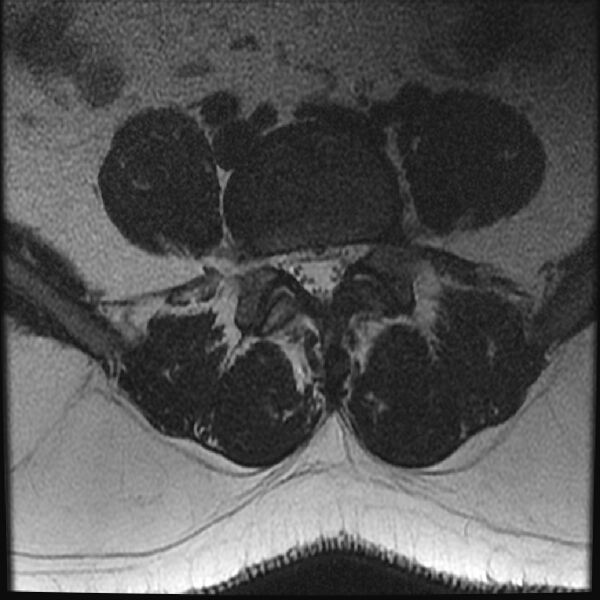 File:Normal lumbar spine MRI (Radiopaedia 43051-46311 Axial T2 20).jpg