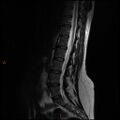 Normal spine MRI (Radiopaedia 77323-89408 Sagittal T2 6).jpg