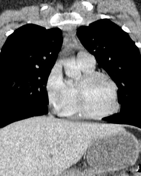 File:Normal thymus (Radiopaedia 39553-41859 B 1).jpg