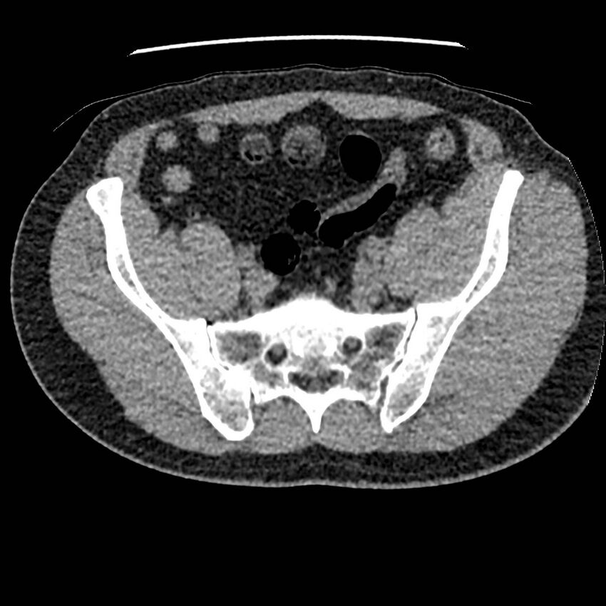 Obstructing ureteric calculus and ureteric anatomy (Radiopaedia 62730-71042 Axial non-contrast 122).jpg