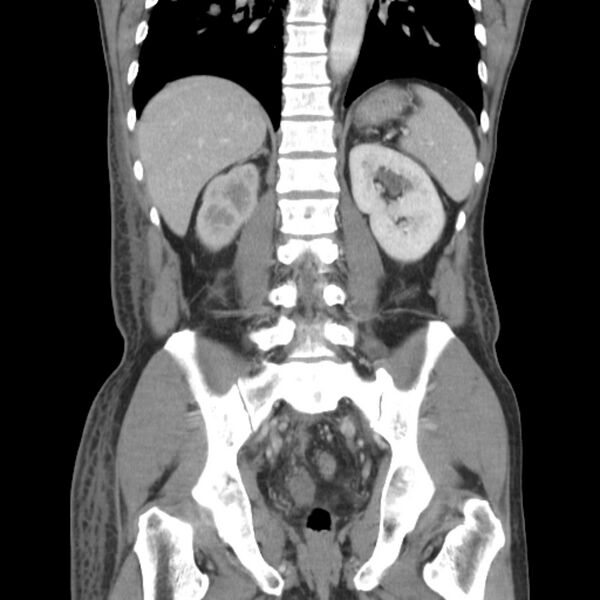 File:Obstructive bladder transitional cell carcinoma (Radiopaedia 9825-10410 B 19).jpg