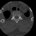 Occipital condyle fracture (Radiopaedia 31755-32691 Axial bone window 86).jpg
