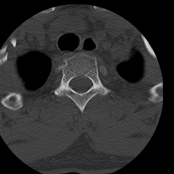 File:Occipital condyle fracture (Radiopaedia 31755-32691 Axial bone window 86).jpg