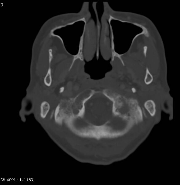 File:Occipital condyle metastasis - into mastoid (Radiopaedia 5424-7177 Axial bone window 3).jpg
