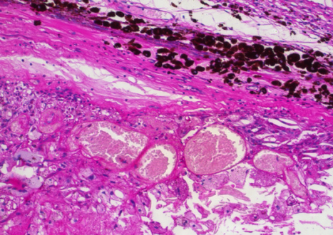 Coats' disease: histopathological findings, telangiectasic retinal vessels