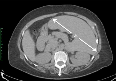Computed tomography shows a massively enlarged spleen ( splenomegaly).
