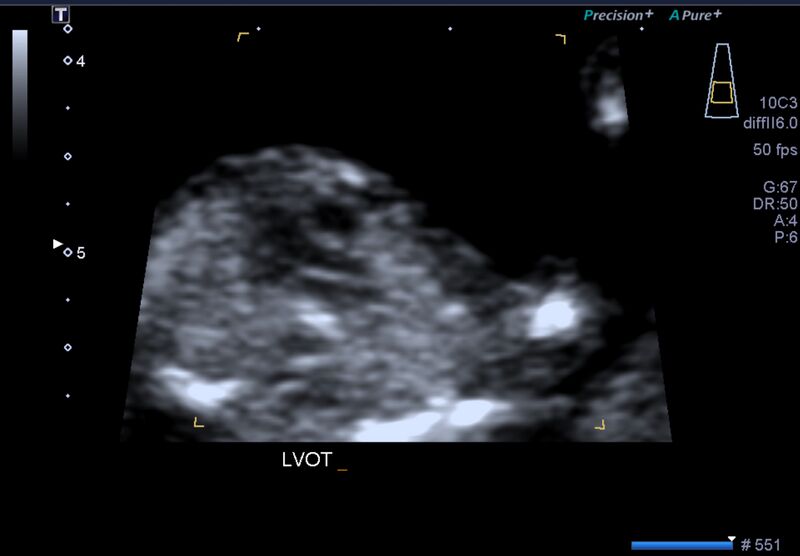 File:1st trimester nuchal-morphology ultrasound (Radiopaedia 44706-48477 General anatomy and NT 18).jpg