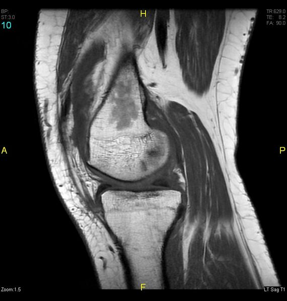 File:ACL mucoid degeration with cystic changes (Radiopaedia 48428-53341 Sagittal T1 8).jpg