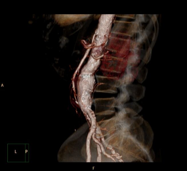 File:Abdominal aortic aneurysm (Radiopaedia 23703-23856 3D 19).jpg