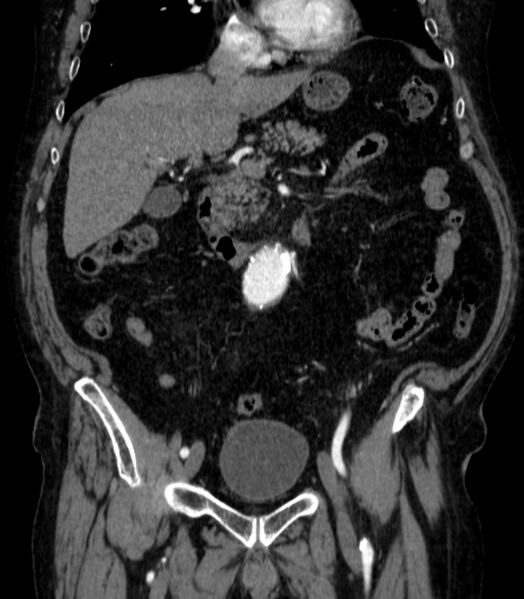 File:Abdominal aortic aneurysm (Radiopaedia 25855-26001 Coronal C+ arterial phase 21).jpg