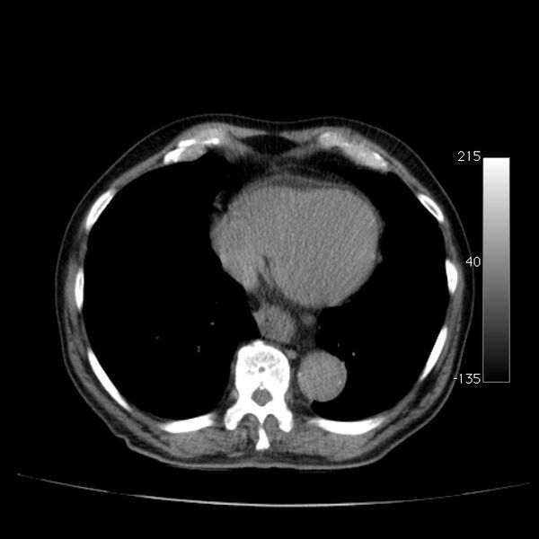 File:Abdominal aortic aneurysm (Radiopaedia 29248-29660 Axial non-contrast 5).jpg