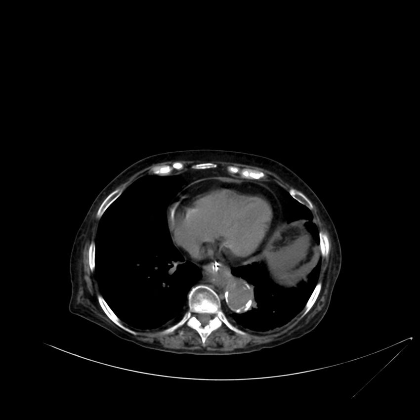 Abdominal aortic aneurysm - impending rupture (Radiopaedia 19233-19246 Axial non-contrast 13).jpg