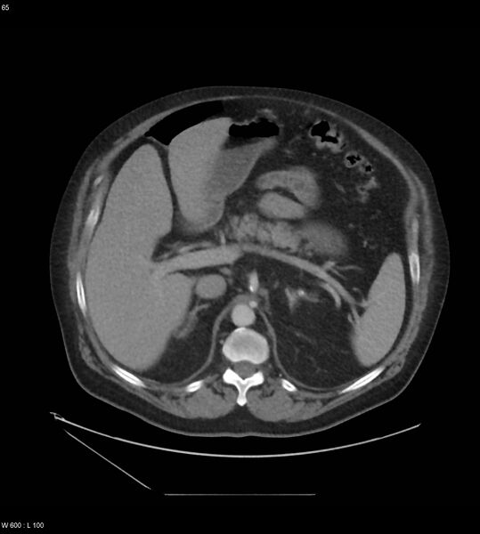 File:Abdominal aortic aneurysm with intramural hematoma then rupture (Radiopaedia 50278-55631 Axial C+ arterial phase 56).jpg