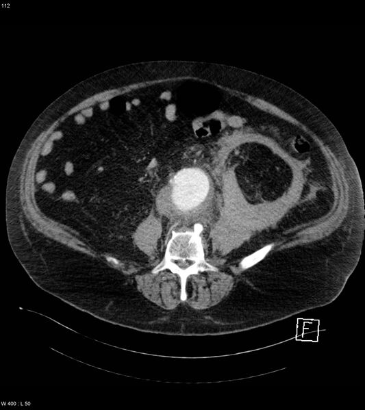 File:Abdominal aortic aneurysm with intramural hematoma then rupture (Radiopaedia 50278-55632 Axial C+ arterial phase 111).jpg