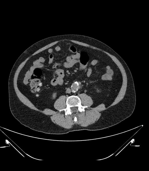 File:Abdominal aortic aneurysm with thrombus fissuration (Radiopaedia 46218-50618 Axial non-contrast 30).jpg