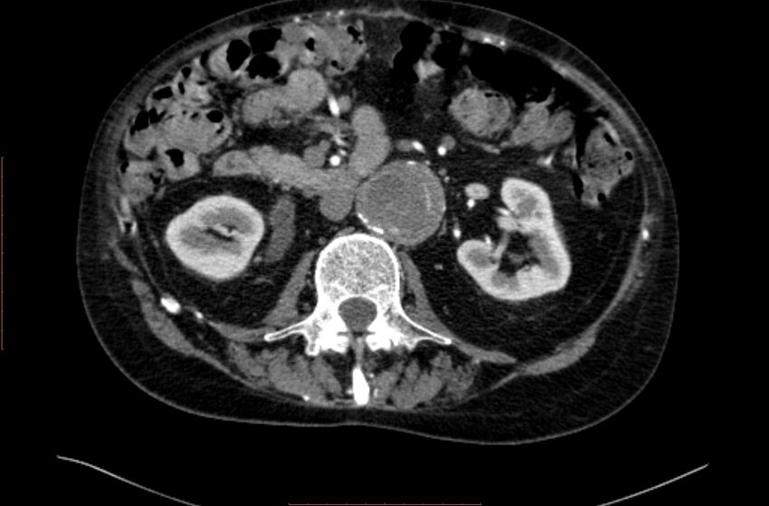 Abdominal aortic interposition tube graft and aneurysm thrombosis (Radiopaedia 71438-81857 Axial C+ arterial phase 65).jpg