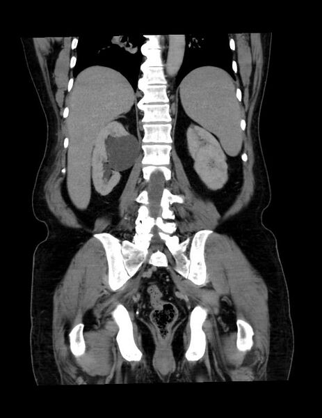 File:Abdominal lymphoma - with sandwich sign (Radiopaedia 53486-59492 C+ portal venous phase 16).jpg