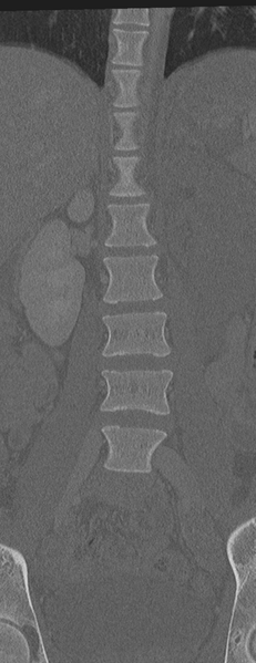 File:Abdominal multi-trauma - devascularised kidney and liver, spleen and pancreatic lacerations (Radiopaedia 34984-36486 Coronal bone window 21).png