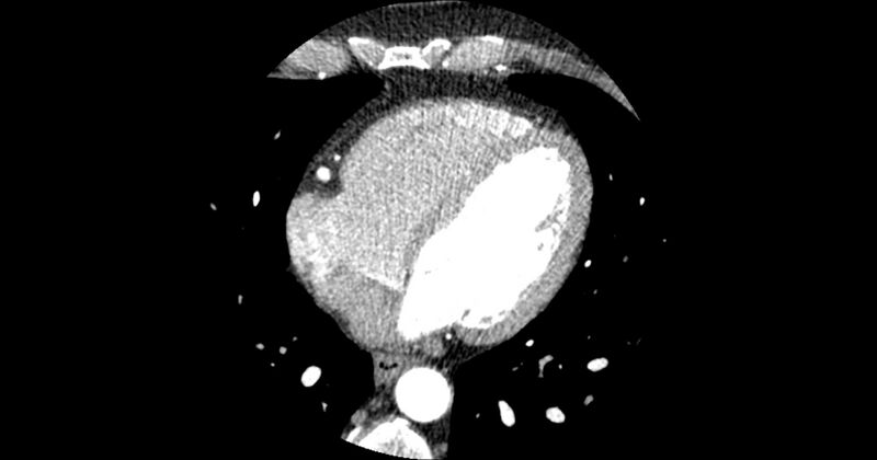 File:Aberrant left main coronary artery (ALMCA) arising from the right sinus with interarterial course (Radiopaedia 63251-71814 Axial C+ arterial phase 124).JPG