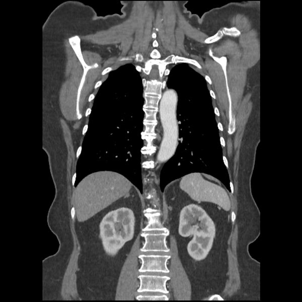 File:Aberrant right subclavian and left vertebral arteries (Radiopaedia 43467-46847 Coronal C+ portal venous phase 62).jpg