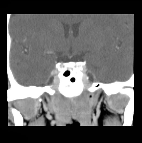 File:Acinic cell carcinoma of the lacrimal gland (Radiopaedia 9480-10160 Coronal C+ arterial phase 13).jpg