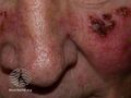 Actinic Keratoses treated with imiquimod (DermNet NZ lesions-ak-imiquimod-3734).jpg