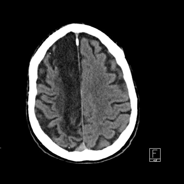 File:Acute ICA ischemic penumbra due to high-grade CCA stenosis (CT perfusion) (Radiopaedia 72038-82529 Axial non-contrast 36).jpg