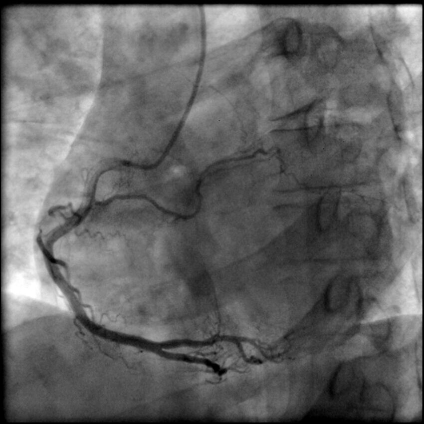 Acute anteroseptal myocardial infarction (Radiopaedia 68409-77946 RAO straight RCA 39).jpg