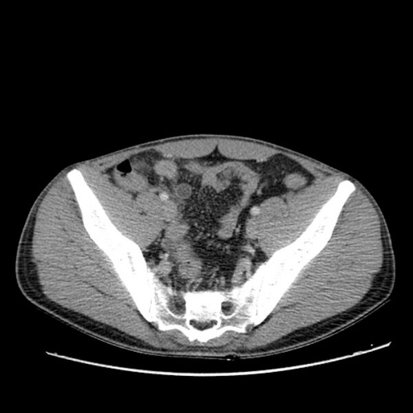 File:Acute appendicitis (Radiopaedia 27049-27227 Axial C+ portal venous phase 60).jpg