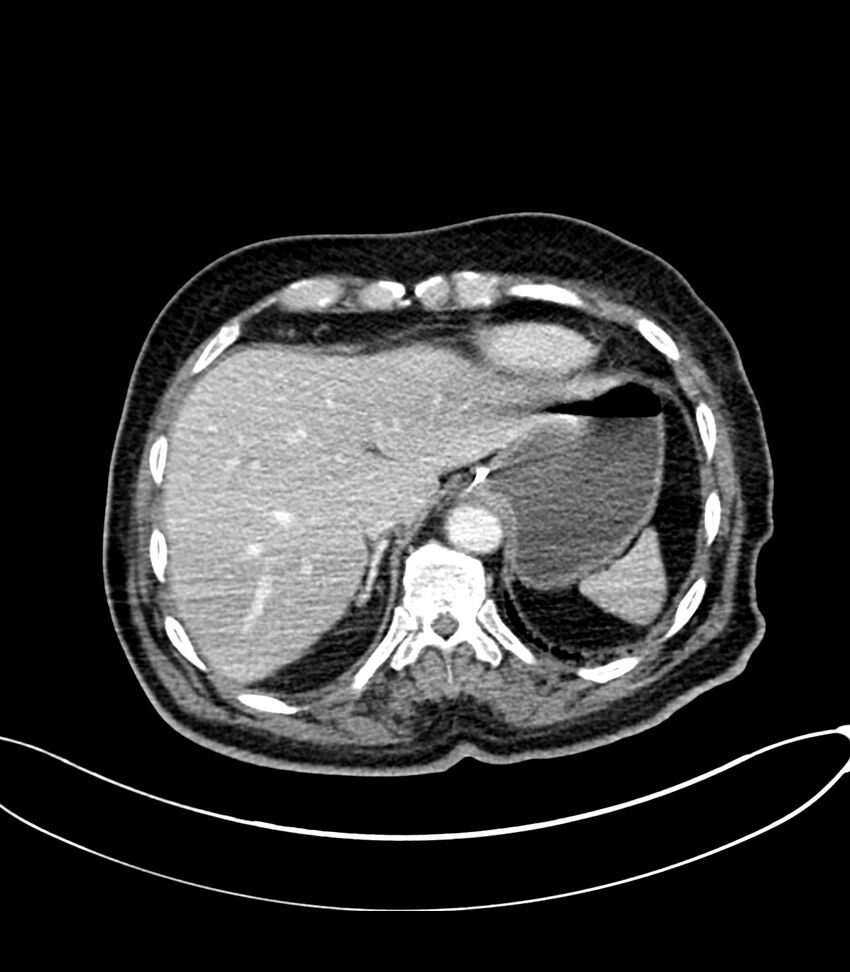 Acute arterial mesenteric ischemia (Radiopaedia 78238-90828 Axial C+ portal venous phase 27).jpg