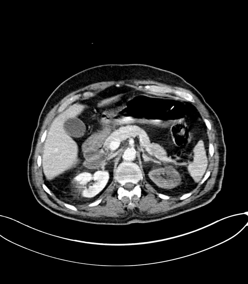 Acute arterial mesenteric ischemia (Radiopaedia 78238-90828 Axial C+ portal venous phase 44).jpg