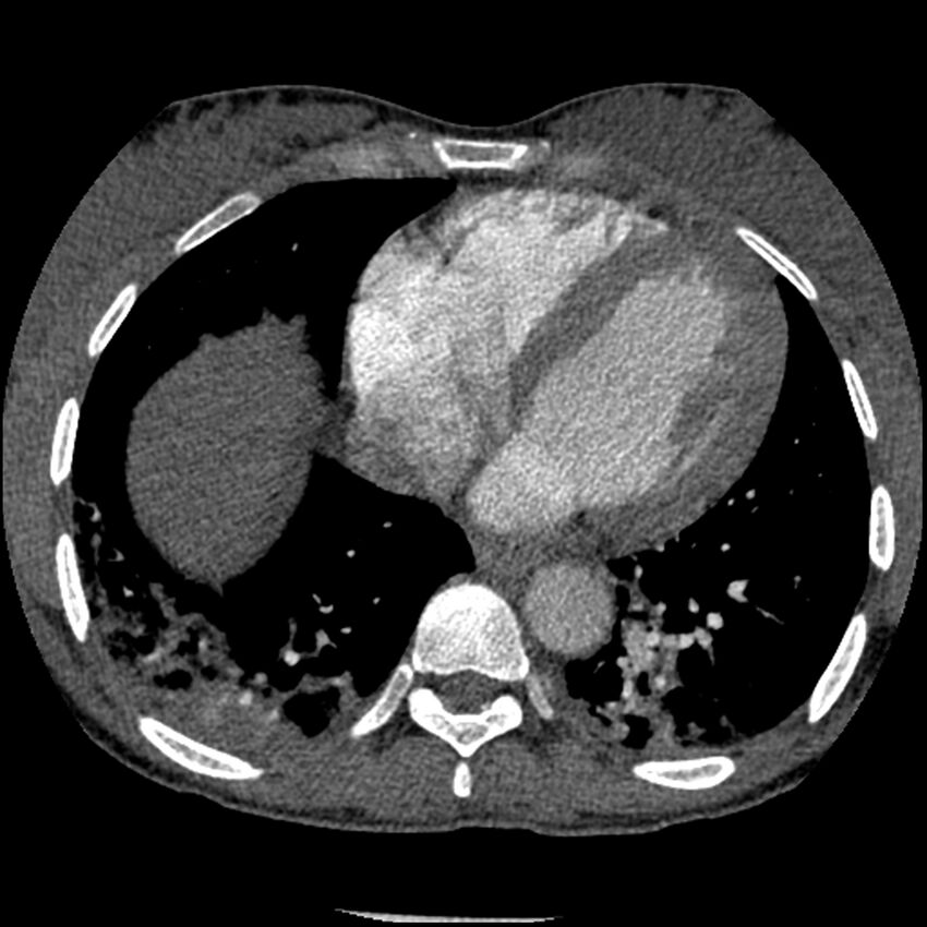 Acute chest syndrome - sickle cell disease (Radiopaedia 42375-45499 Axial C+ CTPA 135).jpg