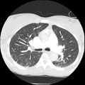Acute chest syndrome - sickle cell disease (Radiopaedia 42375-45499 Axial lung window 75).jpg