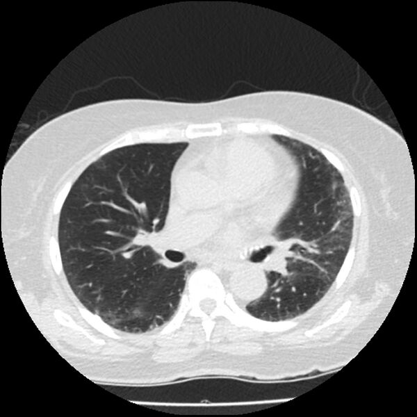 File:Acute interstitial pneumonitis (Radiopaedia 45404-49444 Axial lung window 52).jpg