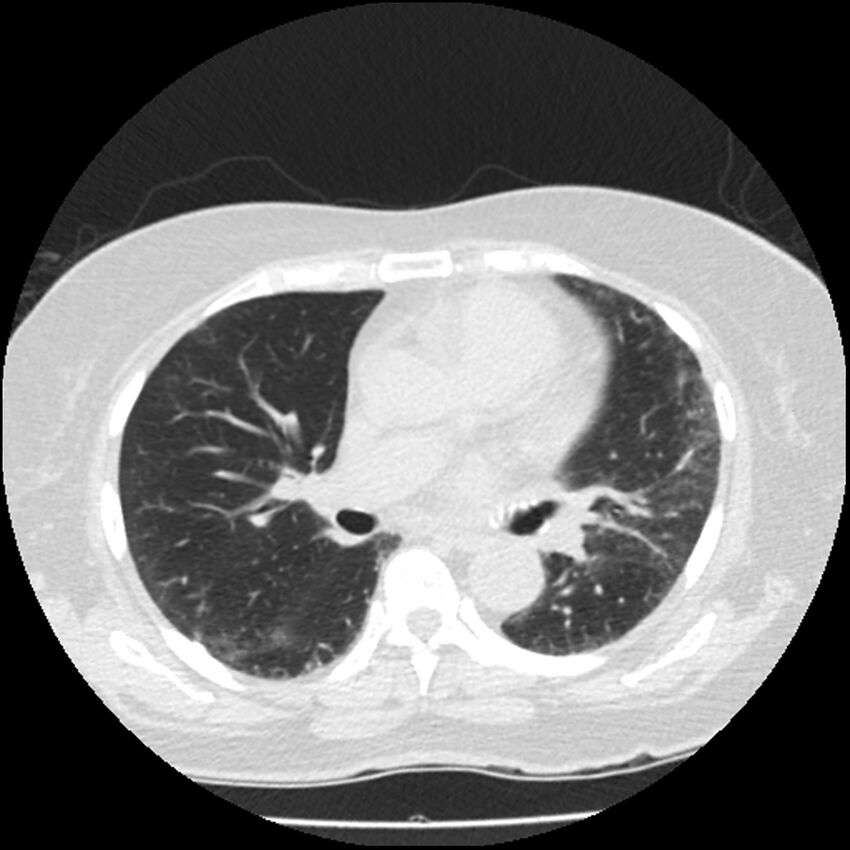 Acute interstitial pneumonitis (Radiopaedia 45404-49444 Axial lung window 52).jpg
