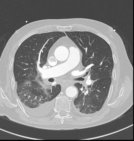 File:Acute myocardial infarction (Radiopaedia 23413-23481 lung window 24).jpg