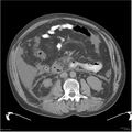 Acute pancreatitis (Radiopaedia 19135-19116 Axial non-contrast 26).jpg