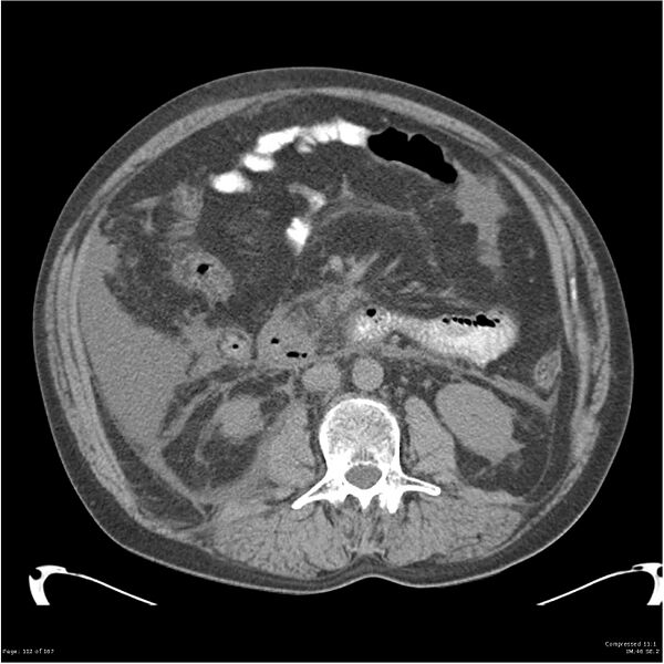 File:Acute pancreatitis (Radiopaedia 19135-19116 Axial non-contrast 26).jpg