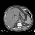 Acute pancreatitis (Radiopaedia 19135-19116 Axial non-contrast 7).jpg