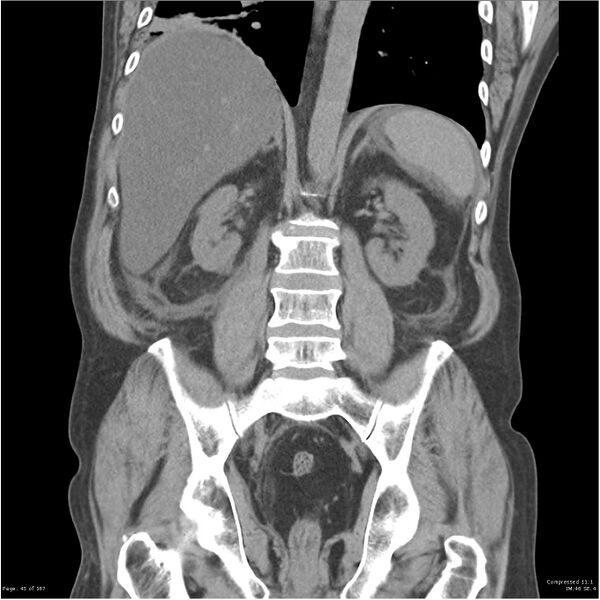 File:Acute pancreatitis (Radiopaedia 19135-19116 Coronal non-contrast 31).jpg