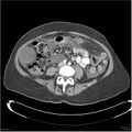 Acute pancreatitis (Radiopaedia 19136-19117 Axial C+ portal venous phase 26).jpg