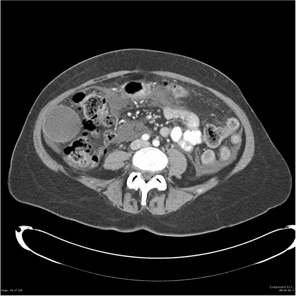 File:Acute pancreatitis (Radiopaedia 19136-19117 Axial C+ portal venous phase 26).jpg