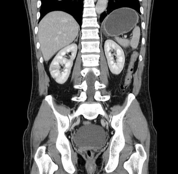 File:Acute pancreatitis (Radiopaedia 22572-22596 Coronal C+ portal venous phase 37).jpg