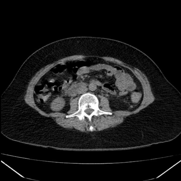File:Acute pancreatitis - Balthazar C (Radiopaedia 26569-26714 Axial non-contrast 51).jpg