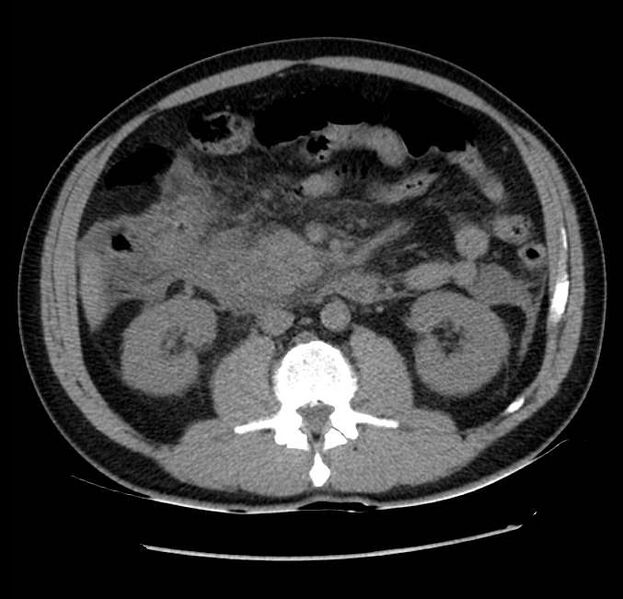 File:Acute pancreatitis - Balthazar E (Radiopaedia 23080-23110 Axial non-contrast 33).jpg