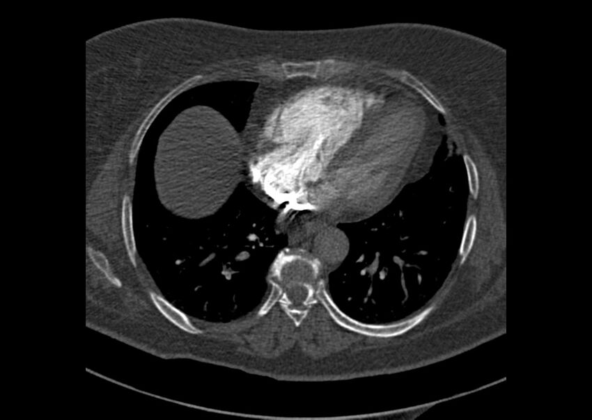 Acute pulmonary embolism (Radiopaedia 29938-30466 Axial C+ CTPA 149).jpg